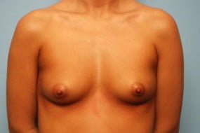 Breast Surgery Breast Augmentation