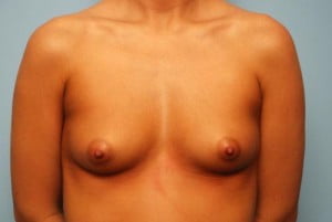 Breast Surgery Breast Augmentation