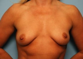 Breast Surgery Breast Lift with Augmentation