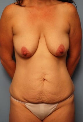 Body Contouring