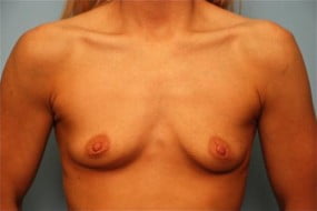 Breast Surgery Breast Augmentation