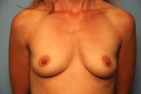 Breast Surgery Breast Augmentation