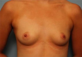 Breast Surgery Breast Augmentation