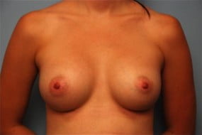 Breast Surgery Breast Augmentation