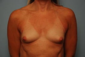 Breast Surgery Breast Augmentation