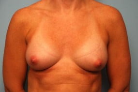 Breast Surgery Breast Augmentation