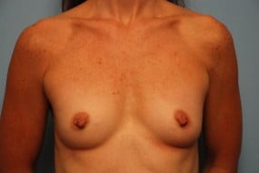 Breast Surgery Breast Augmentation