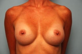 Breast Surgery Breast Augmentation