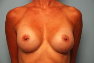 Breast Surgery Breast Augmentation