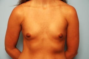 Breast Surgery Breast Augmentation