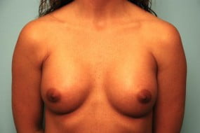 Breast Surgery Breast Augmentation