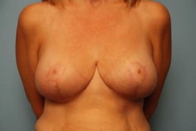 Breast Surgery Breast Lift