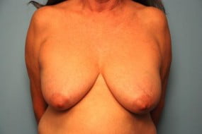 Breast Surgery Breast Lift with Augmentation