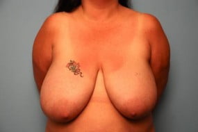 Breast Surgery Breast Reduction