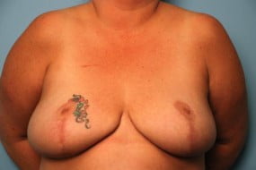 Breast Surgery Breast Reduction