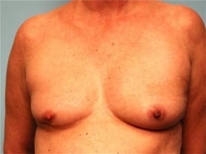 Breast Reconstruction