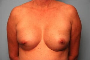 Breast Reconstruction