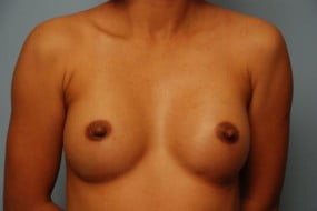 Breast Surgery Breast Augmentation