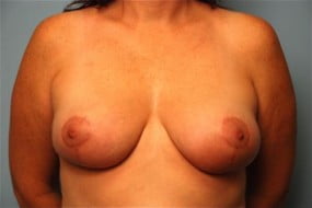 Breast Surgery Breast Reduction