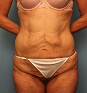 Body Contouring