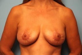 Breast Surgery Breast Lift