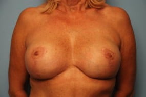 Breast Surgery Breast Lift with Augmentation