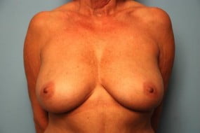 Breast Surgery Breast Lift with Augmentation