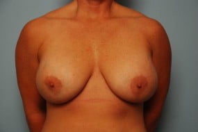 Breast Surgery Breast Lift with Augmentation