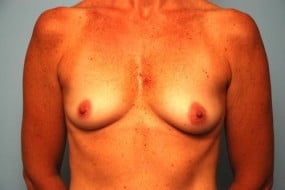 Breast Surgery Breast Augmentation