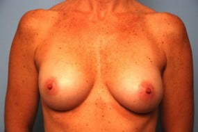 Breast Surgery Breast Augmentation