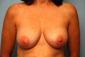 Breast Surgery Breast Implant Revision