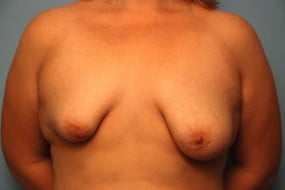 Breast Surgery
