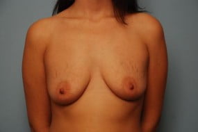 Breast Surgery Breast Lift with Augmentation