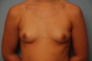 Breast Surgery Breast Augmentation