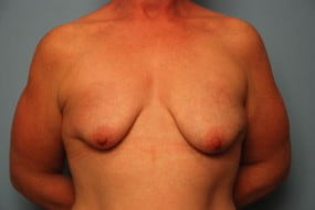 Breast Surgery Breast Asymmetry Correction