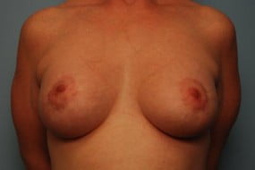 Breast Surgery Breast Asymmetry Correction