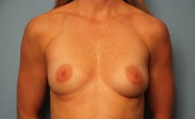 Breast Surgery Breast Augmentation