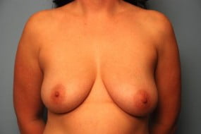 Breast Surgery Breast Asymmetry Correction