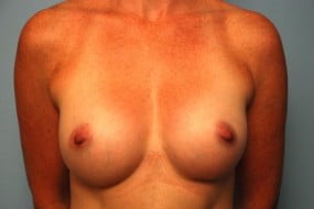 Breast Surgery Breast Augmentation