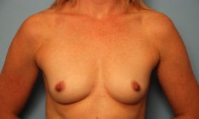 Breast Surgery Breast Augmentation