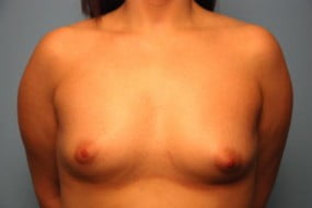 Breast Surgery Breast Augmentation