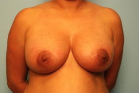 Breast Surgery Breast Lift with Augmentation