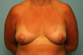 Breast Surgery Breast Asymmetry Correction