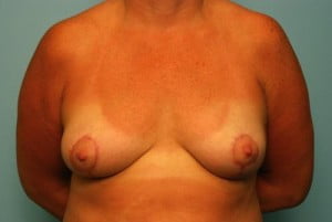Breast Surgery Breast Asymmetry Correction