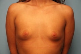 Breast Surgery Breast Augmentation