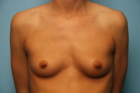 Breast Surgery Breast Augmentation