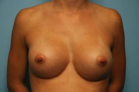 Breast Surgery Breast Augmentation