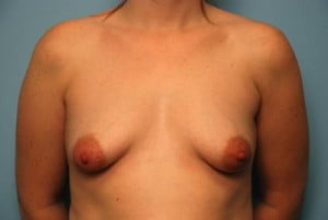 Breast Surgery
