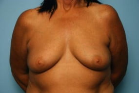 Breast Surgery Breast Lift with Augmentation