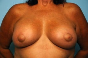 Breast Surgery Breast Lift with Augmentation